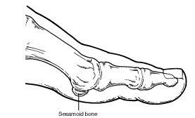sesamoid2.png